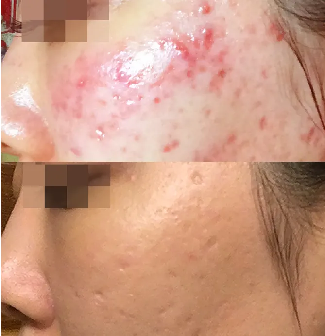 Acne before and after at Glowtique Brisbane