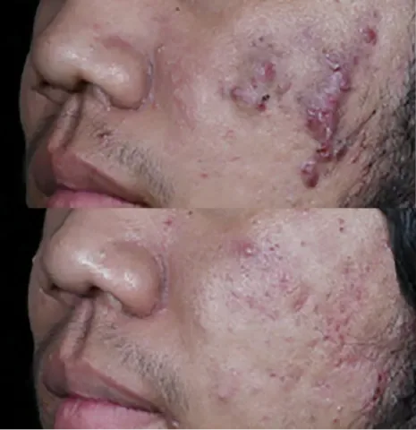 Acne before and after at Glowtique Brisbane