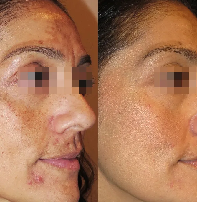 Advanced Melasma Protocol before and after at Glowtique Brisbane