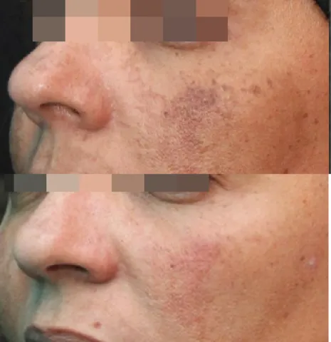 Advanced Melasma Protocol before and after at Glowtique Brisbane