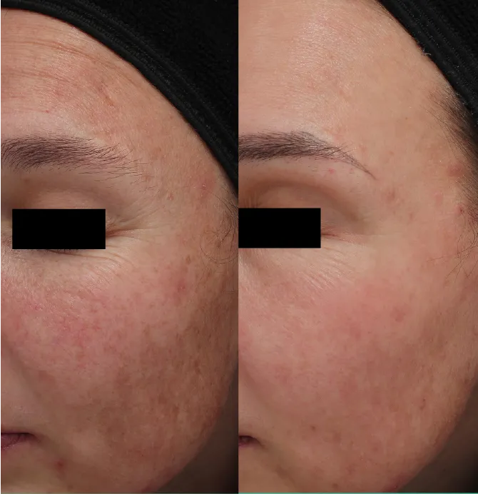 Advanced Melasma Protocol before and after at Glowtique Brisbane