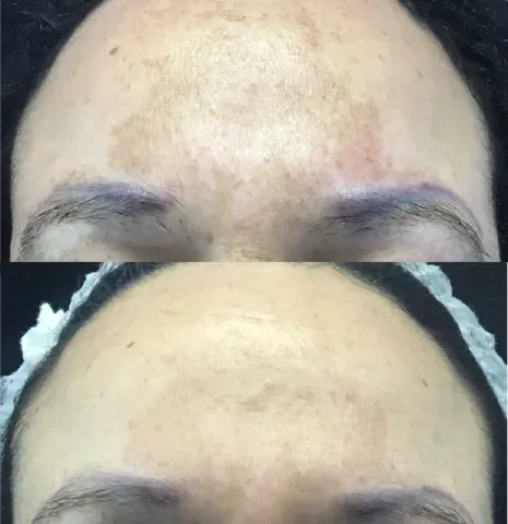 Advanced Melasma Protocol before and after at Glowtique Brisbane