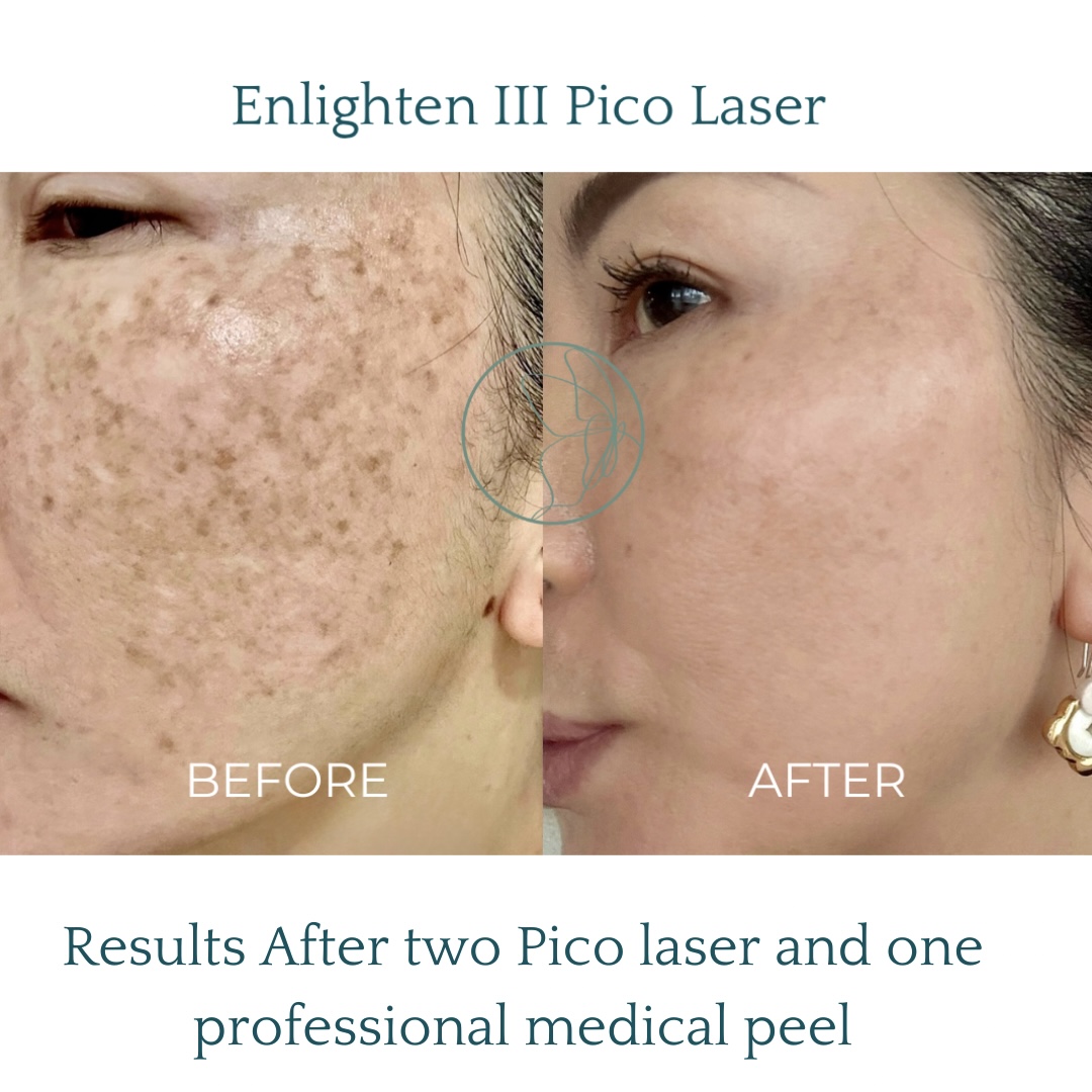 Advanced Melasma Protocol transformation at Glowtique