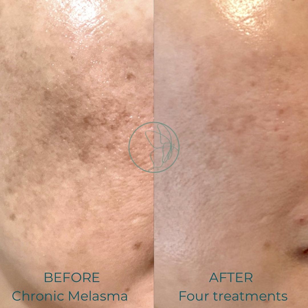 Advanced Melasma Protocol before and after at Glowtique Brisbane