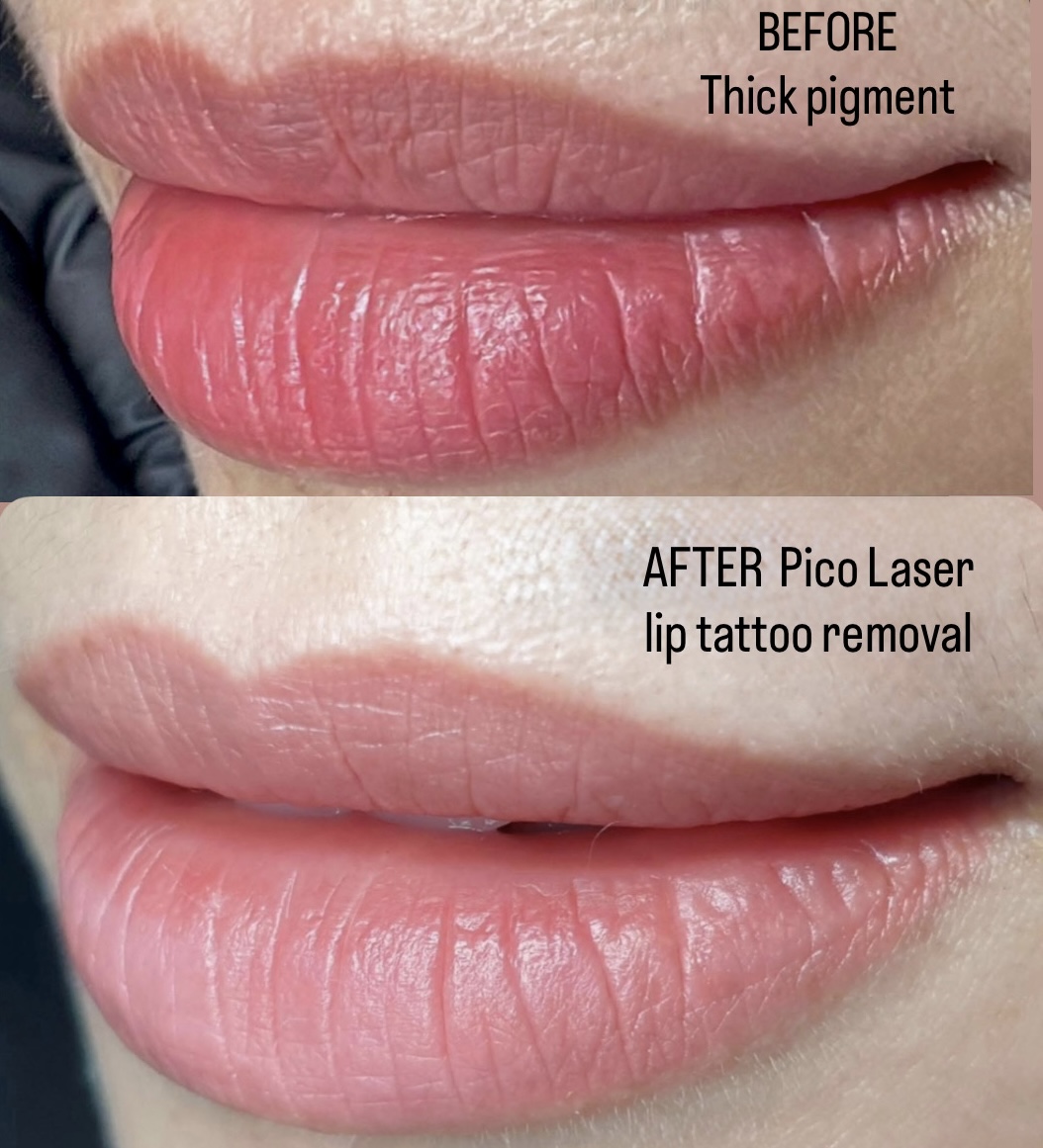 Laser Cosmetic Tattoo Removal transformation at Glowtique