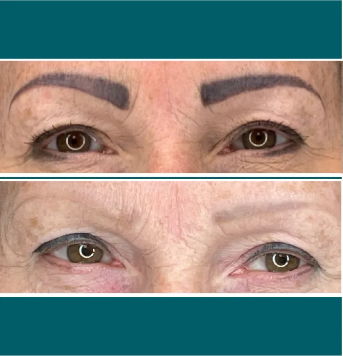 Cosmetic Tattoo Removal before and after at Glowtique Brisbane
