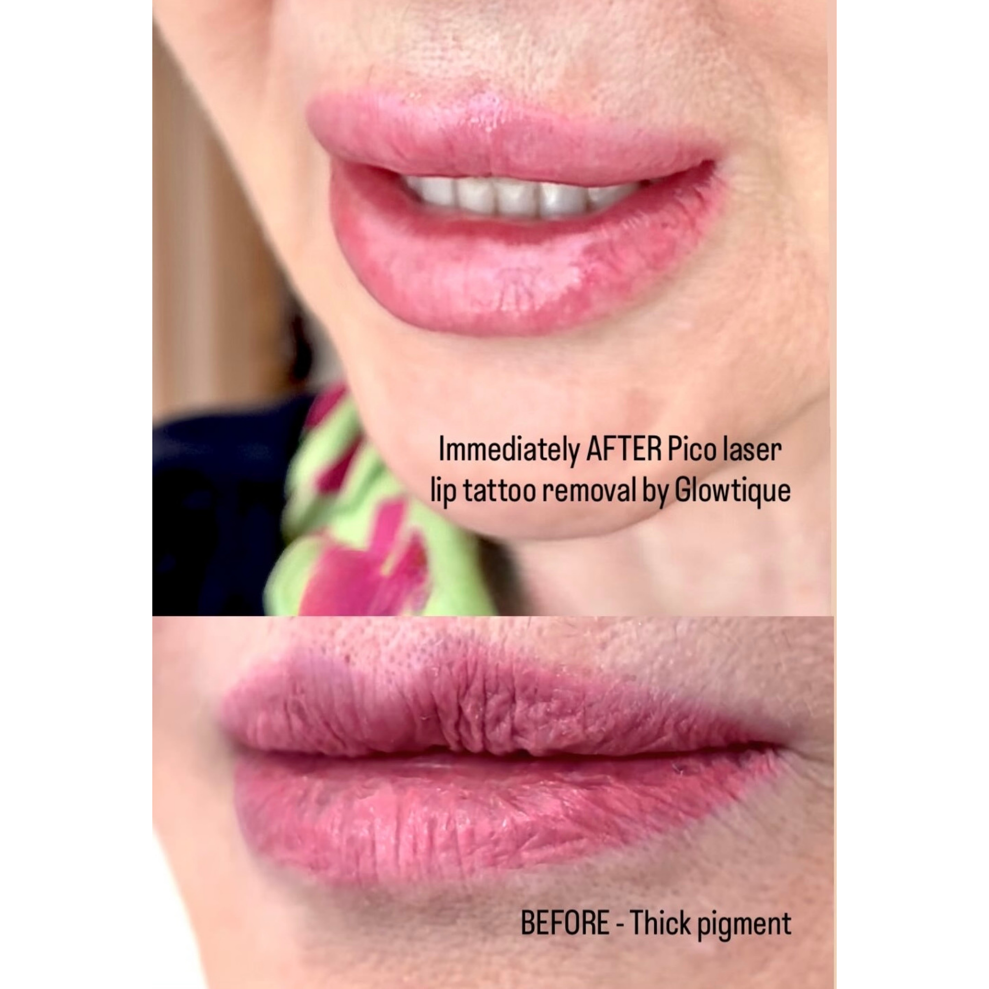 Cosmetic Tattoo Removal before and after at Glowtique Brisbane