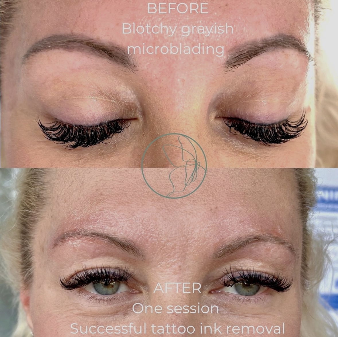Cosmetic Tattoo Removal before and after at Glowtique Brisbane