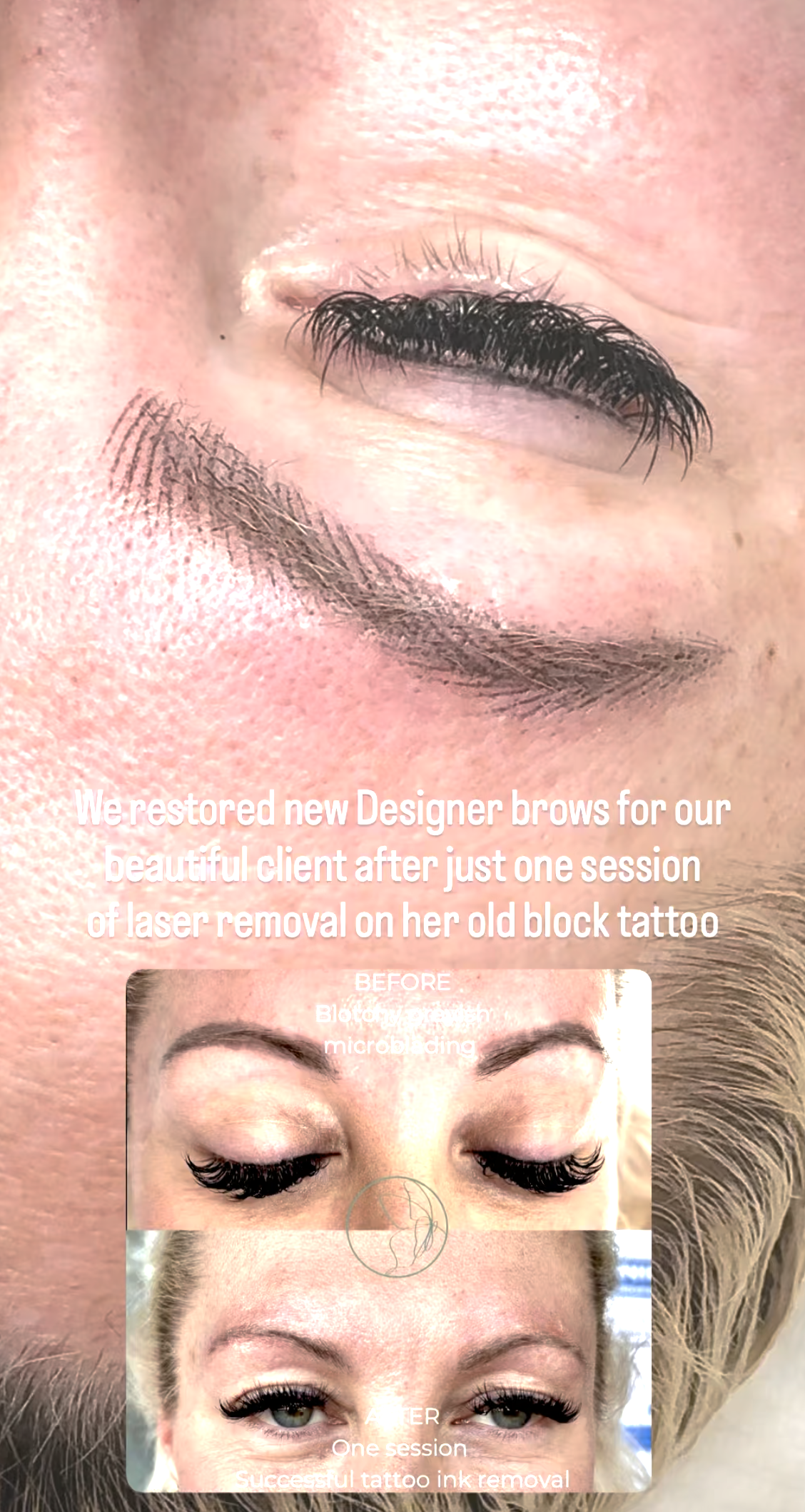 Cosmetic Tattoo Removal before and after at Glowtique Brisbane