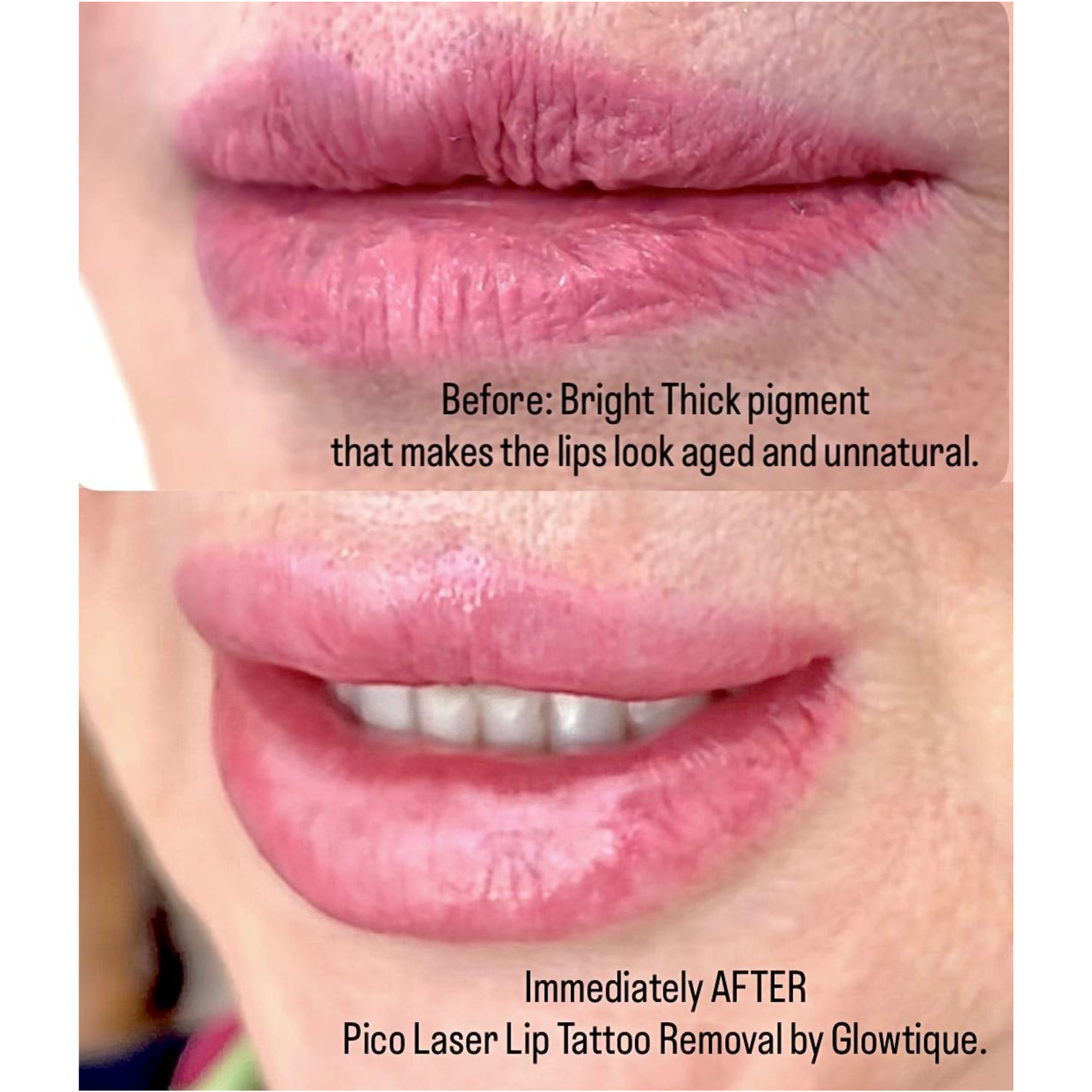 Cosmetic Tattoo Removal before and after at Glowtique Brisbane