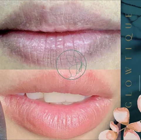 Dark Lips Neutralization before and after at Glowtique Brisbane