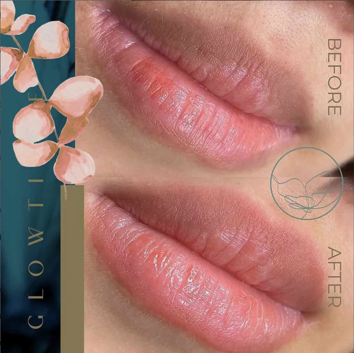 Dark Lips Neutralization before and after at Glowtique Brisbane