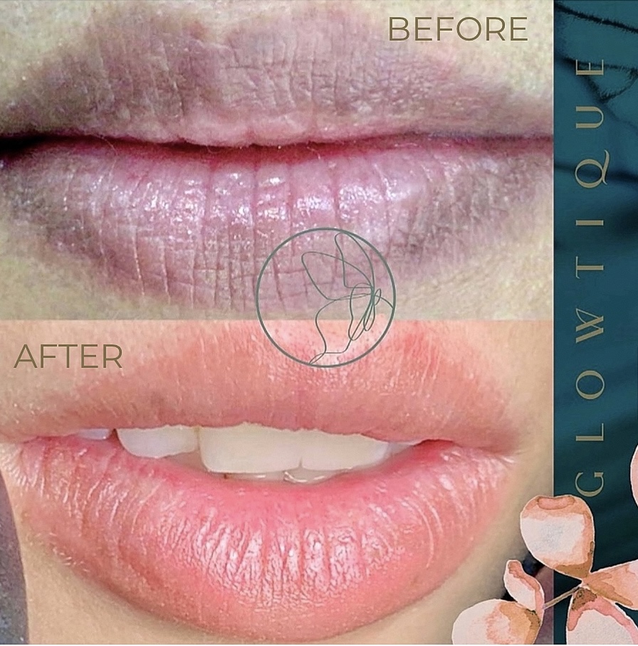 Dark Lips Neutralization before and after at Glowtique Brisbane