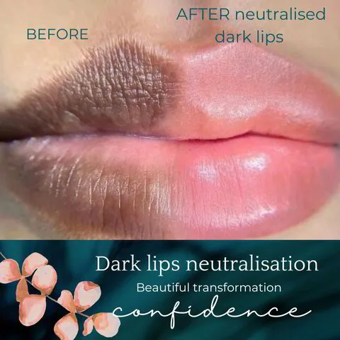 Dark Lips Neutralization before and after at Glowtique Brisbane