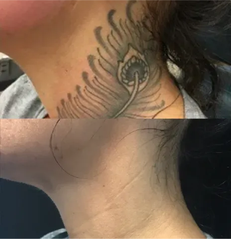 Laser Body Tattoo Removal before and after at Glowtique Brisbane