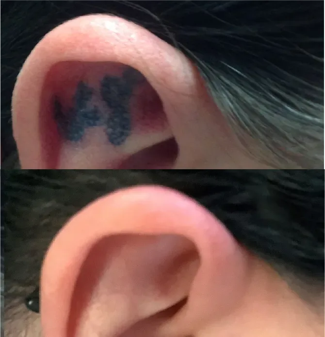 Laser Body Tattoo Removal before and after at Glowtique Brisbane