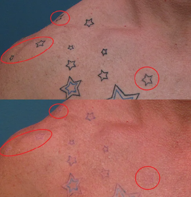 Laser Body Tattoo Removal before and after at Glowtique Brisbane