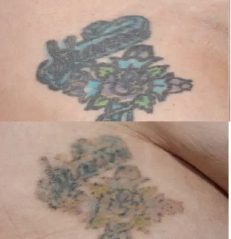 Laser Body Tattoo Removal before and after at Glowtique Brisbane