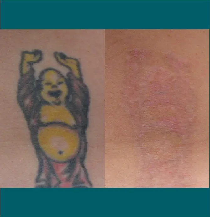 Laser Body Tattoo Removal before and after at Glowtique Brisbane