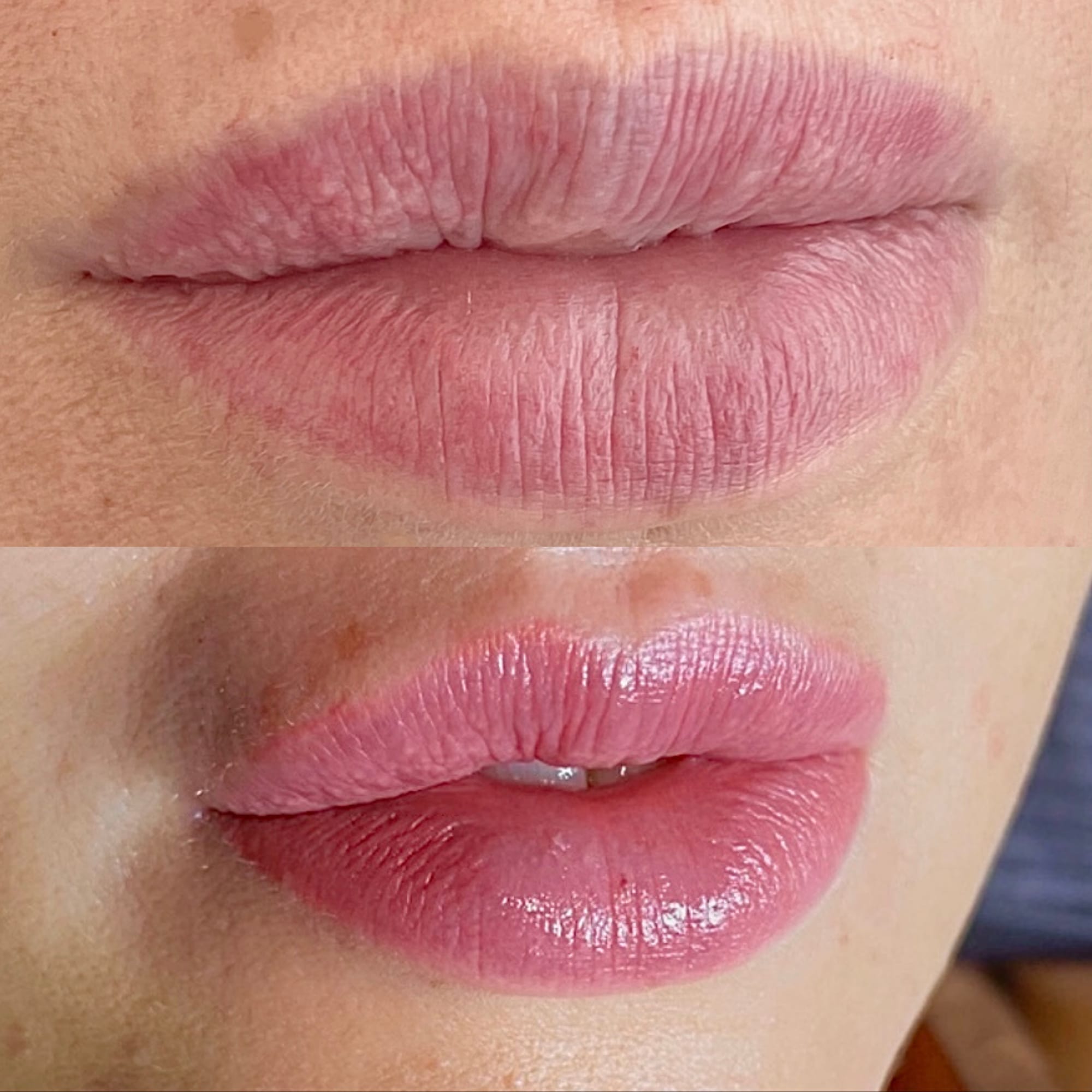 Lip Correction before and after at Glowtique Brisbane