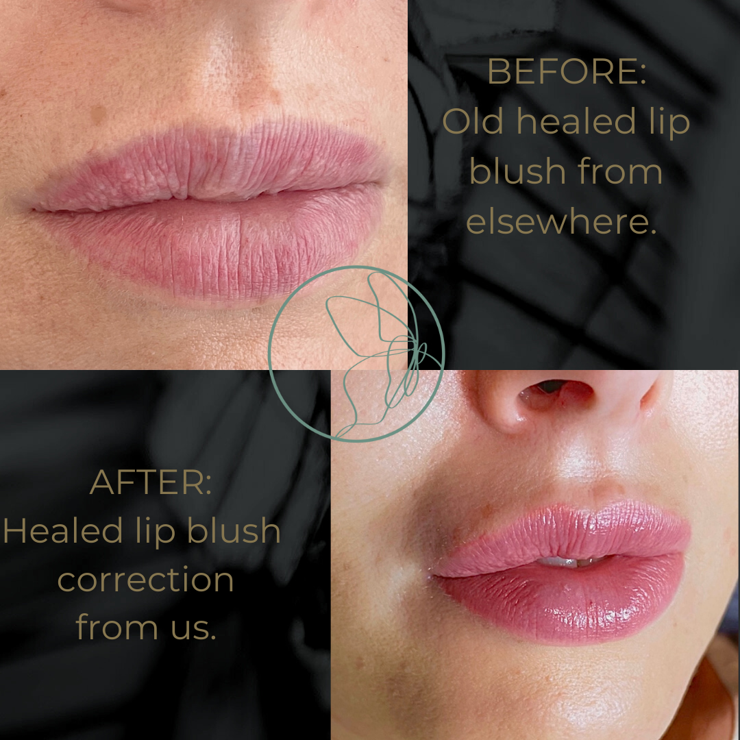 Lip Correction before and after at Glowtique Brisbane