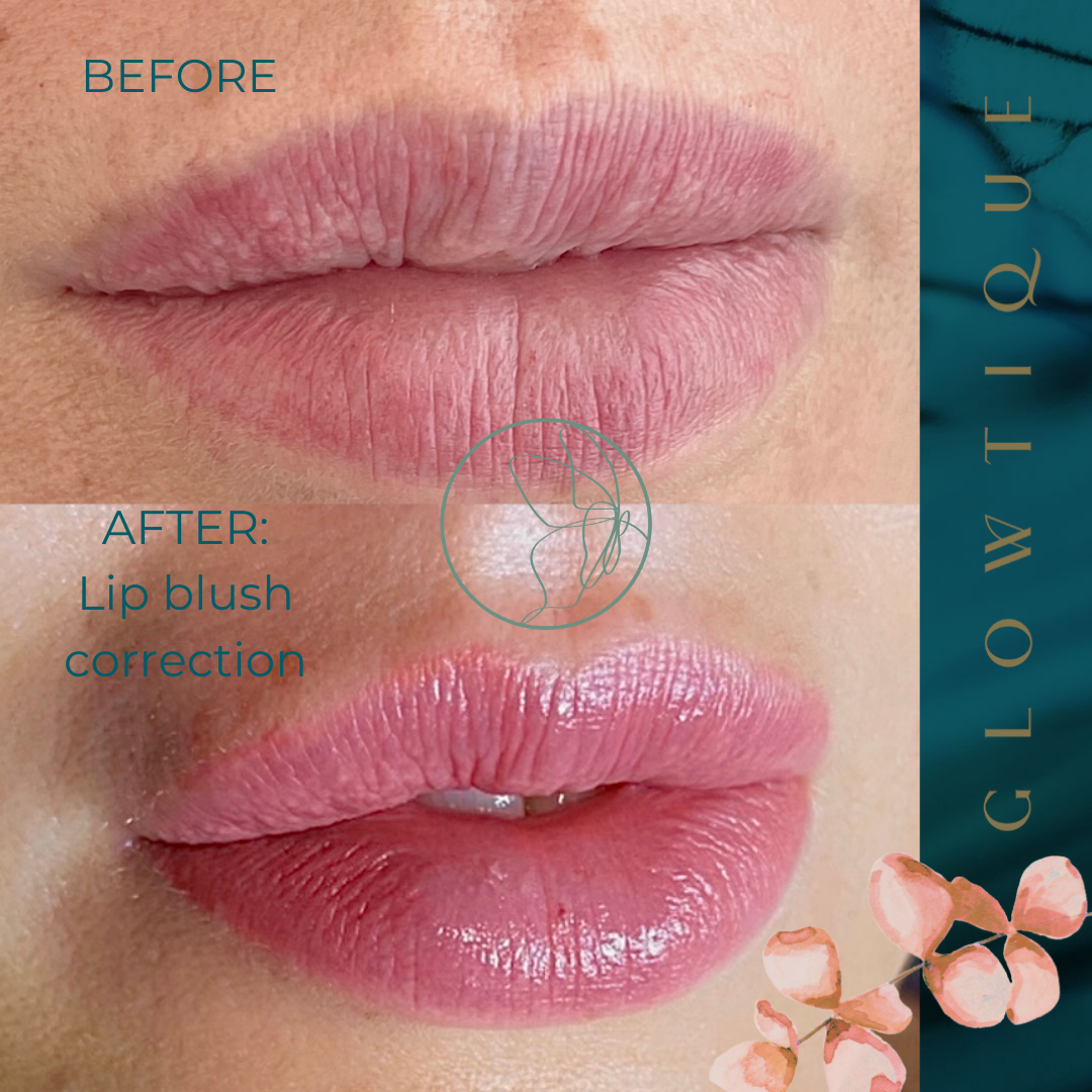 Lip Correction before and after at Glowtique Brisbane