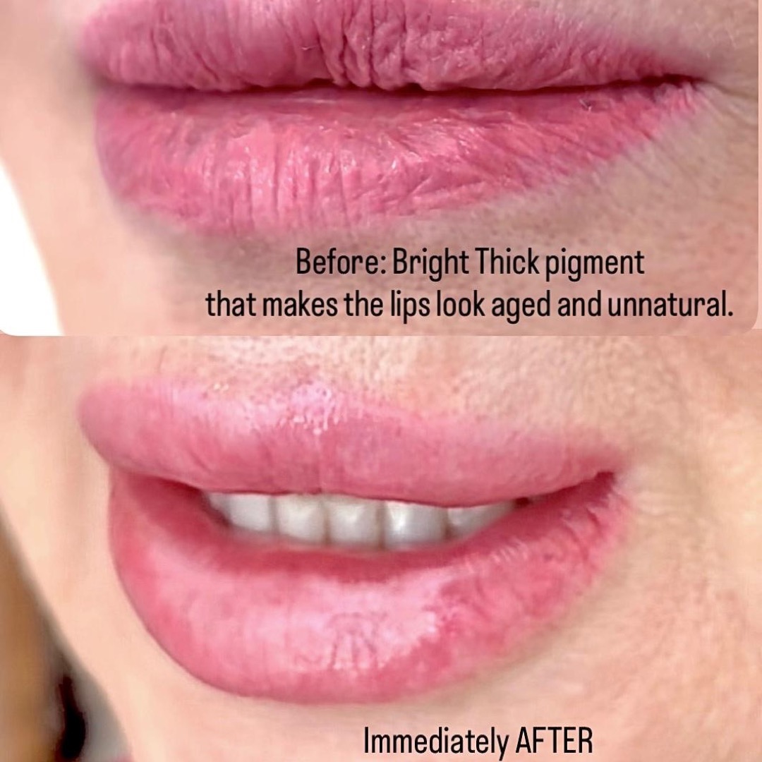 Lip Correction before and after at Glowtique Brisbane