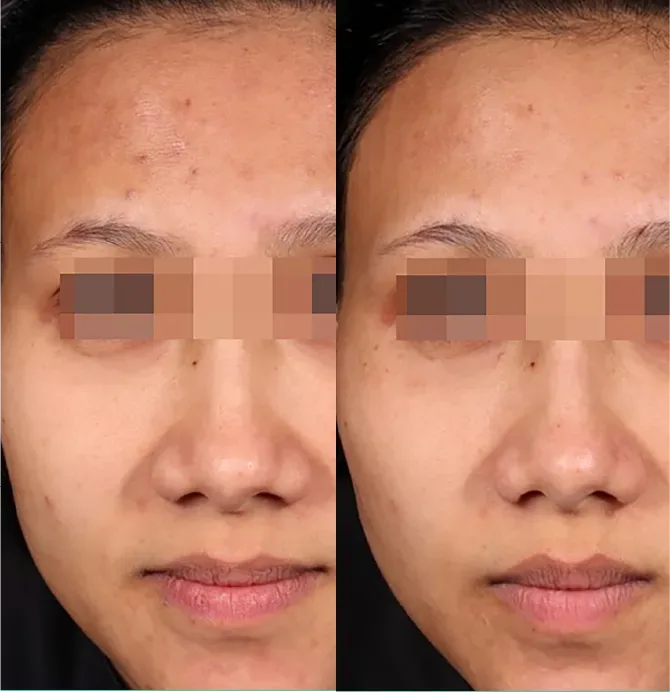 Pico Genesis FX before and after at Glowtique Brisbane