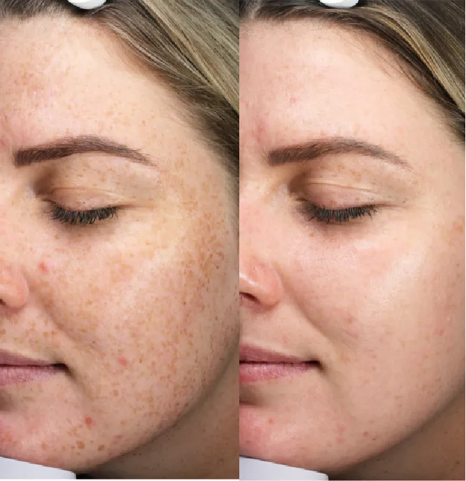 Pigmentation Solutions before and after at Glowtique Brisbane