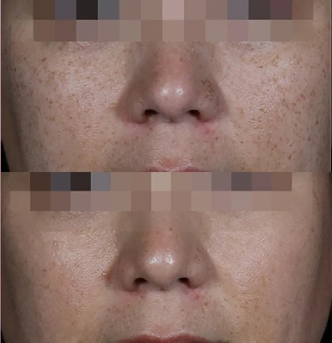Pigmentation Solutions before and after at Glowtique Brisbane