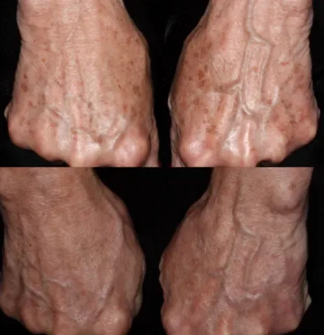 Pigmentation Solutions before and after at Glowtique Brisbane