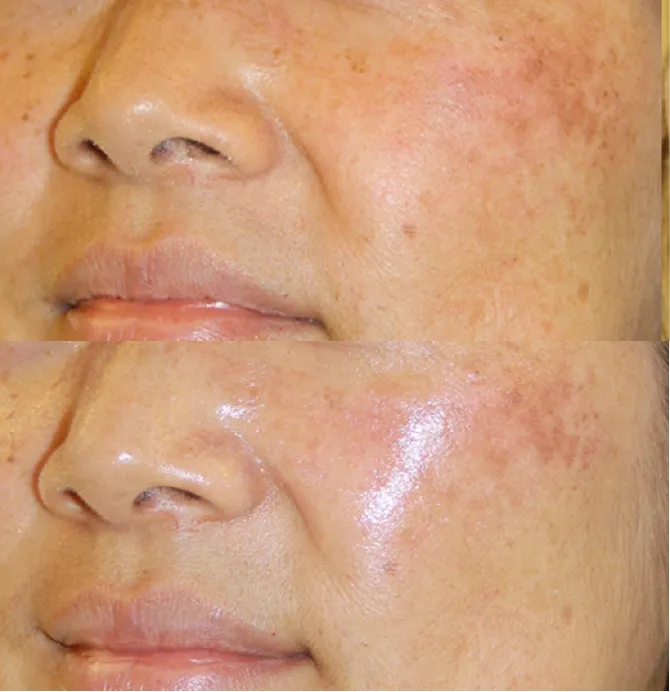 Pigmentation Solutions before and after at Glowtique Brisbane