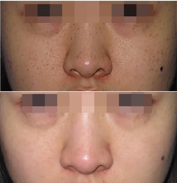 Pigmentation Solutions before and after at Glowtique Brisbane