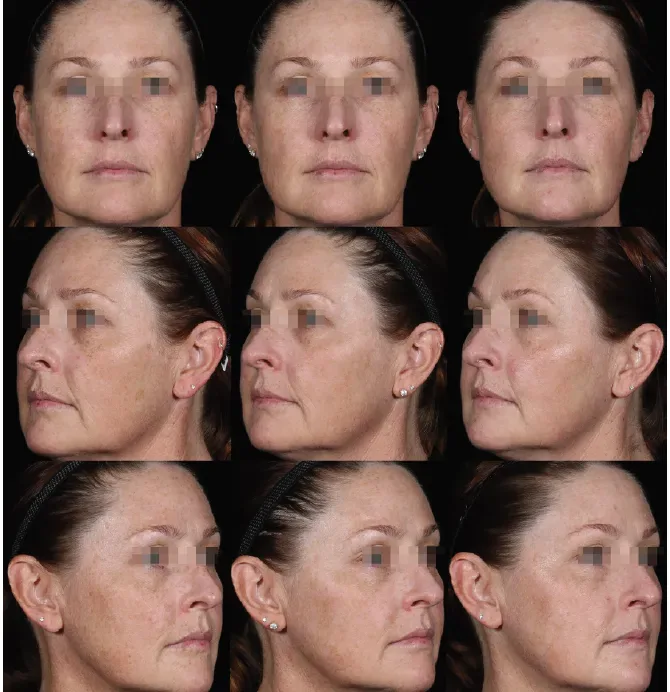 Pigmentation Solutions before and after at Glowtique Brisbane