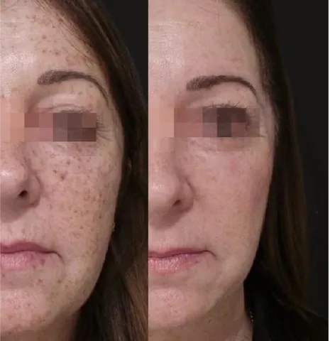 Pigmentation Solutions before and after at Glowtique Brisbane