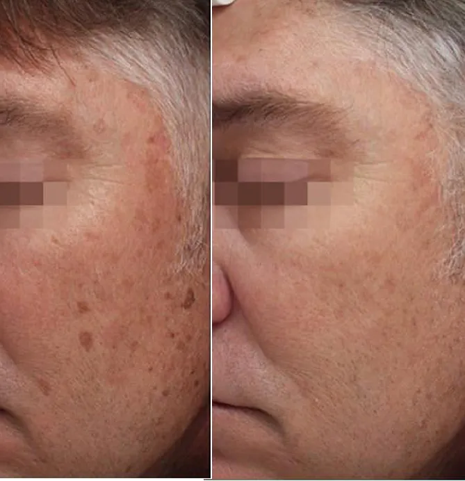 Pigmentation Solutions before and after at Glowtique Brisbane