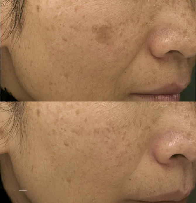 Pigmentation Solutions before and after at Glowtique Brisbane