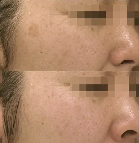 Pigmentation Solutions before and after at Glowtique Brisbane