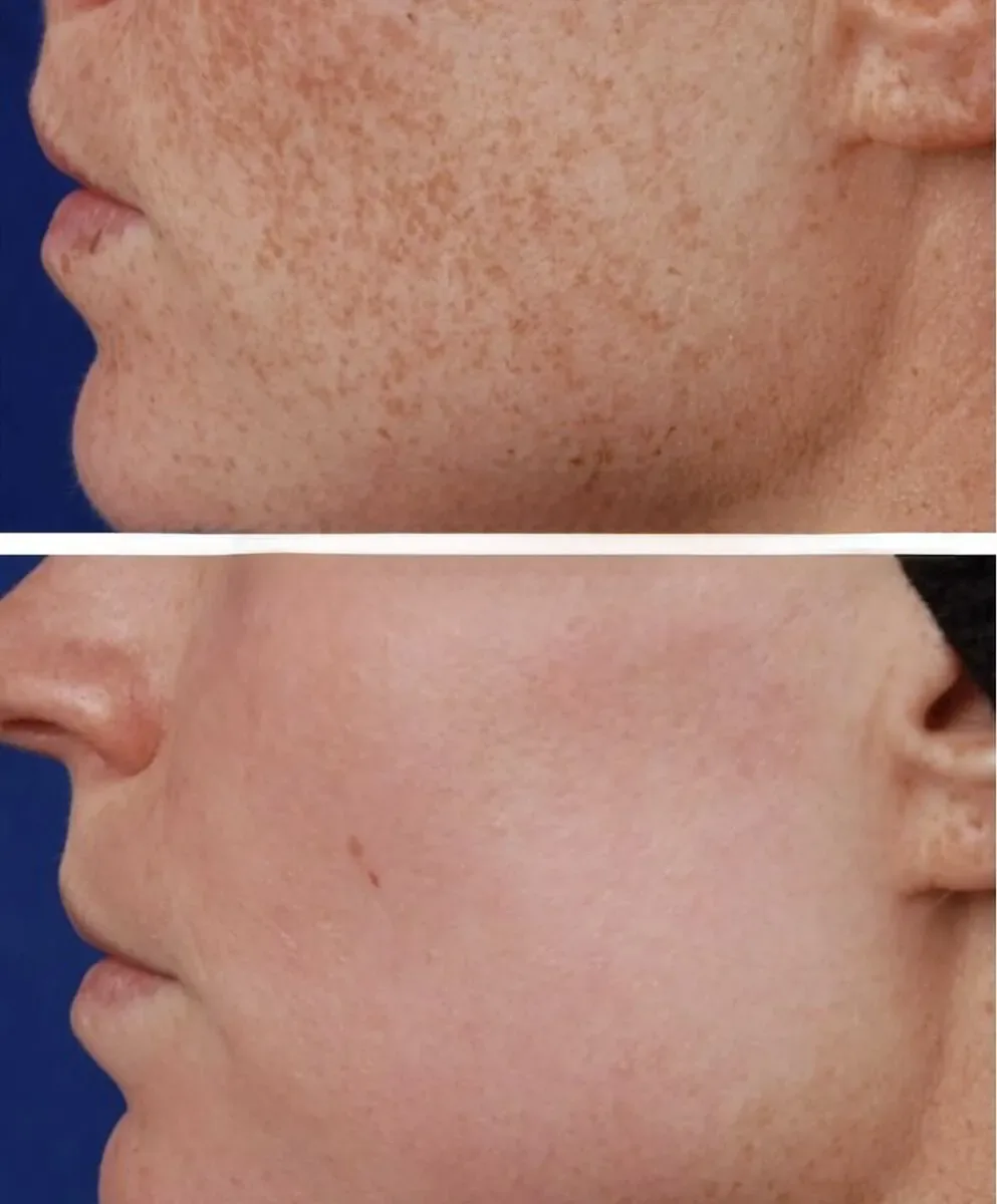 Pigmentation Solutions before and after at Glowtique Brisbane