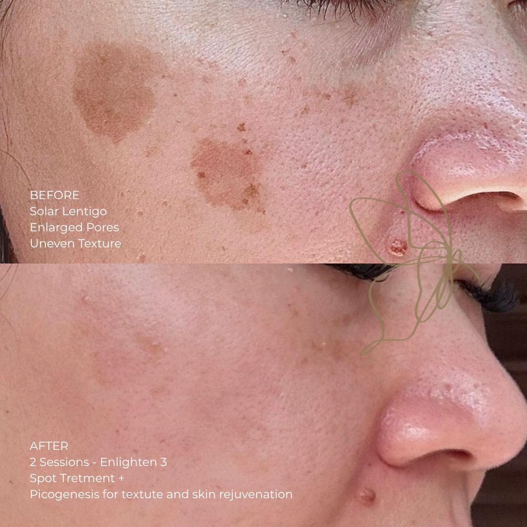 Pigmentation Solutions before and after at Glowtique Brisbane