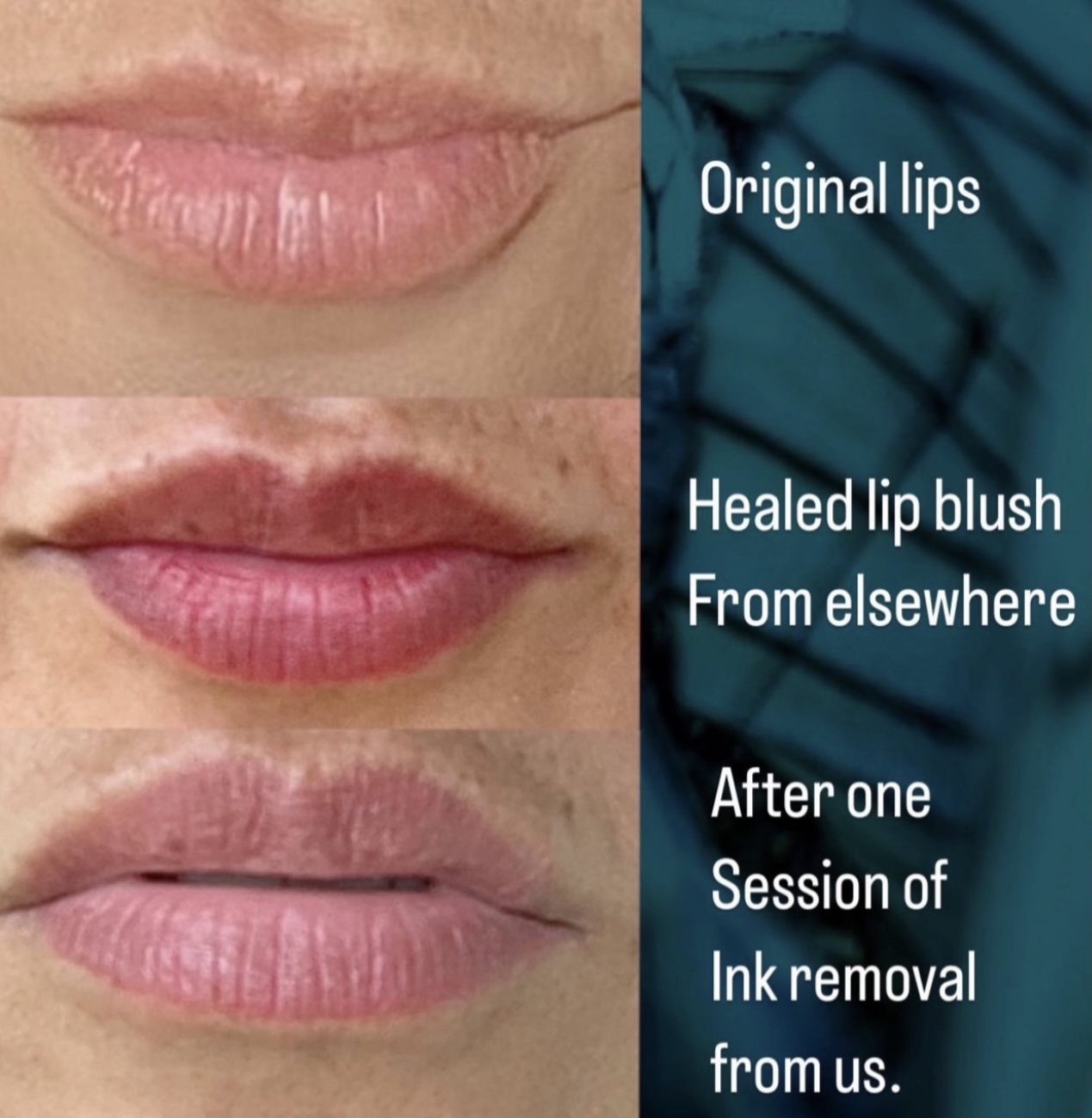 Saline Pigment Removal transformation at Glowtique