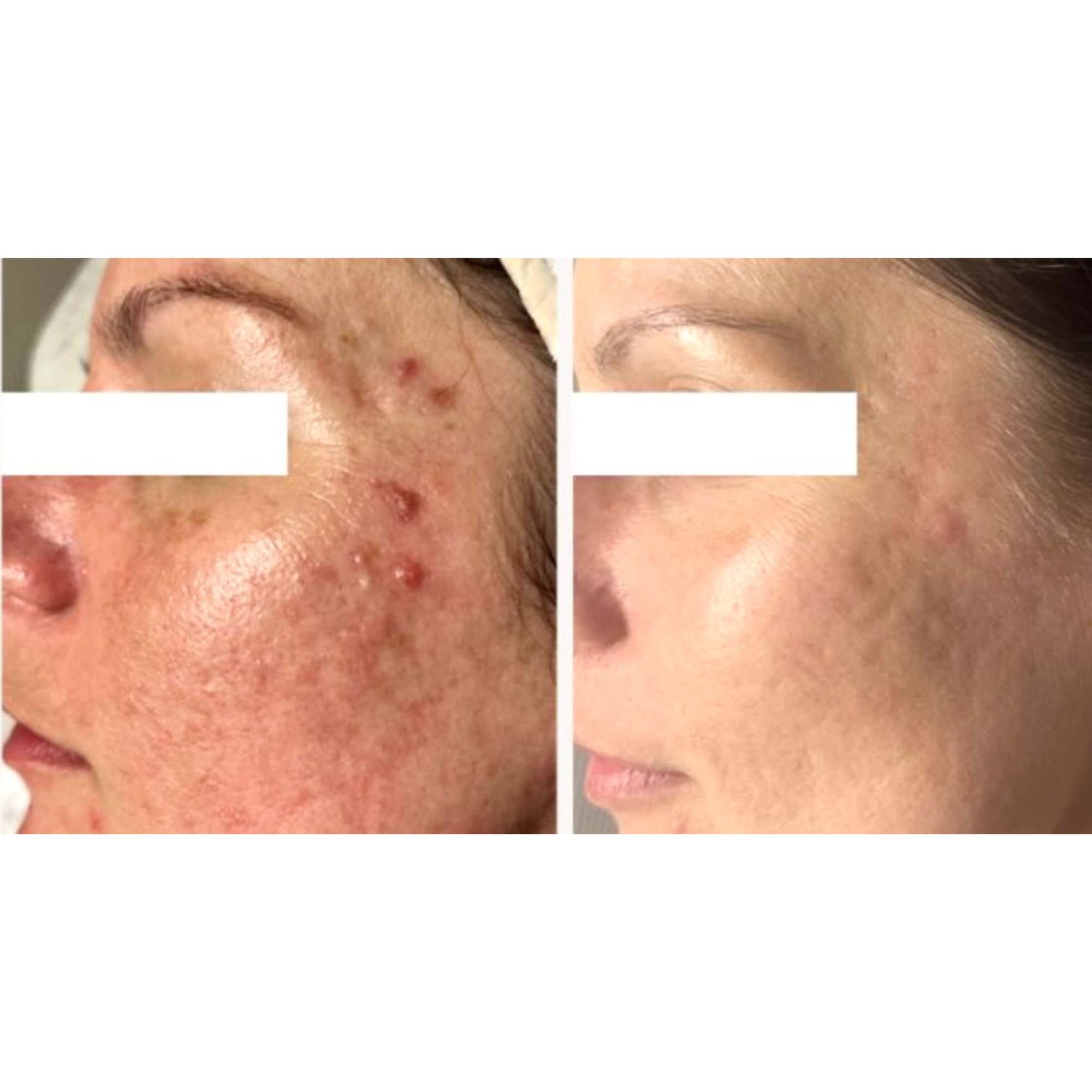 Skin Peel Treatments transformation at Glowtique
