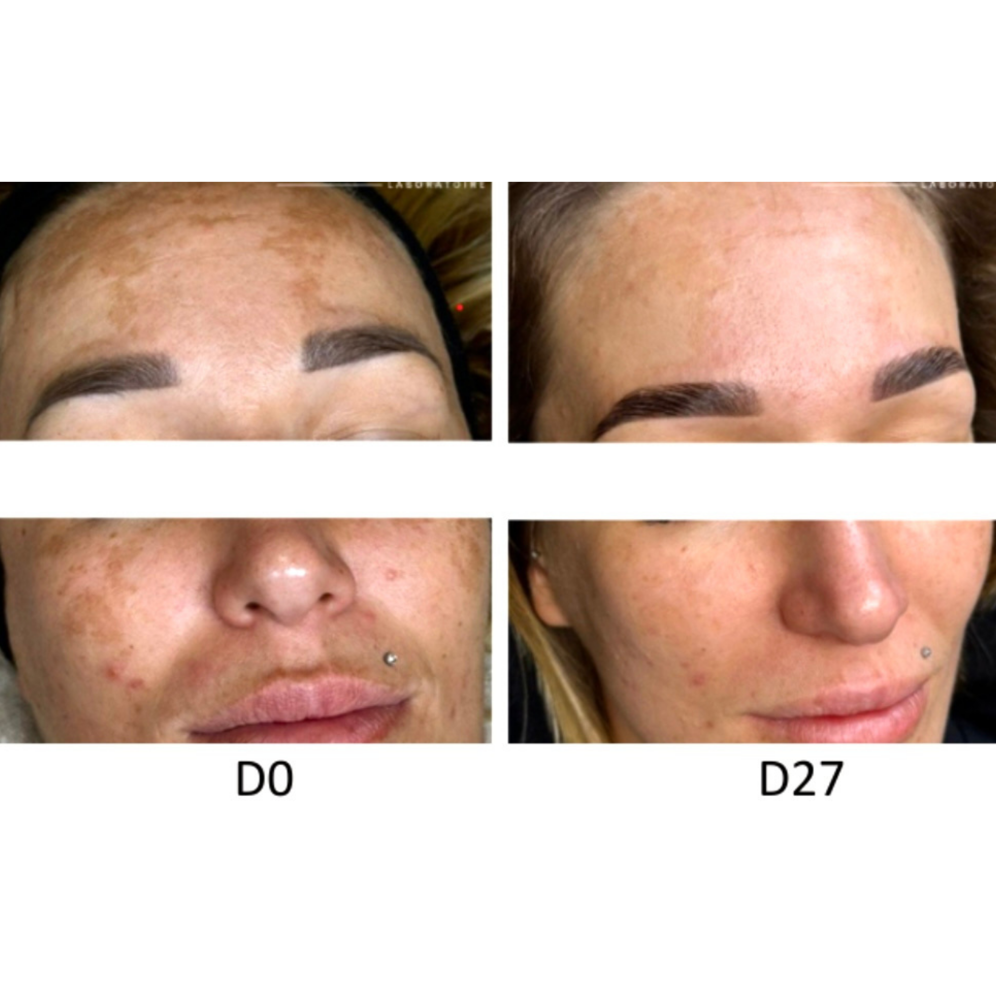 Skin Peel Treatments before and after at Glowtique Brisbane