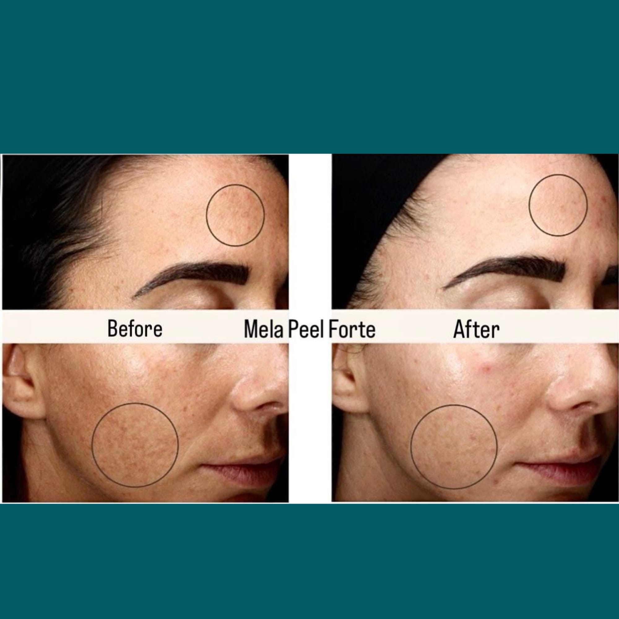 Skin Peel Treatments before and after at Glowtique Brisbane