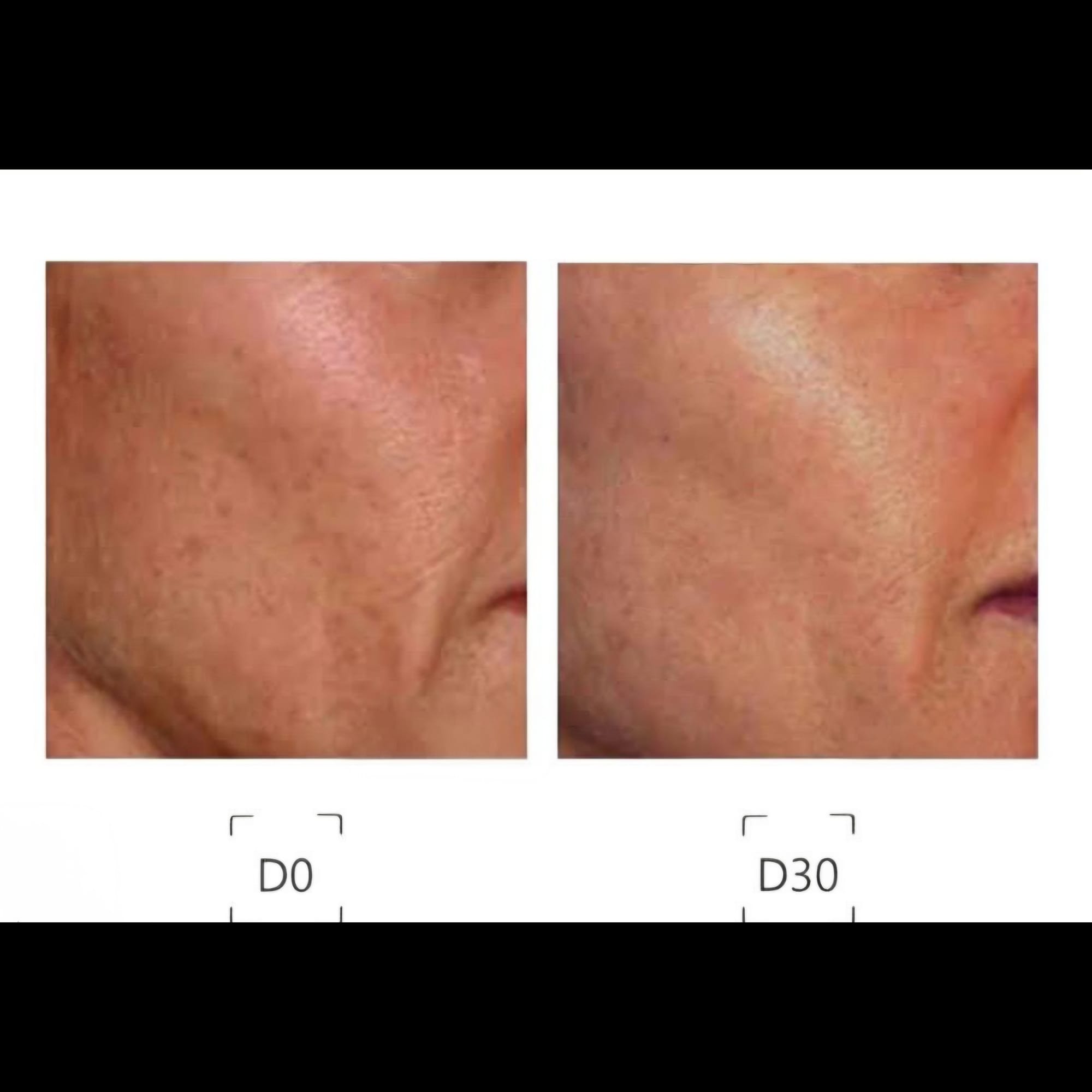 Skin Peel Treatments before and after at Glowtique Brisbane