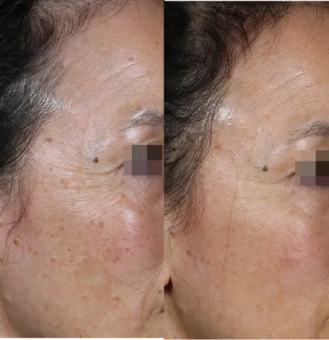 Skin Rejuvenation Solutions before and after at Glowtique Brisbane