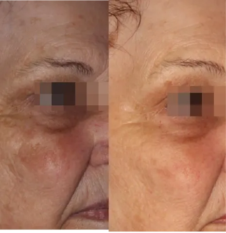 Skin Rejuvenation Solutions before and after at Glowtique Brisbane
