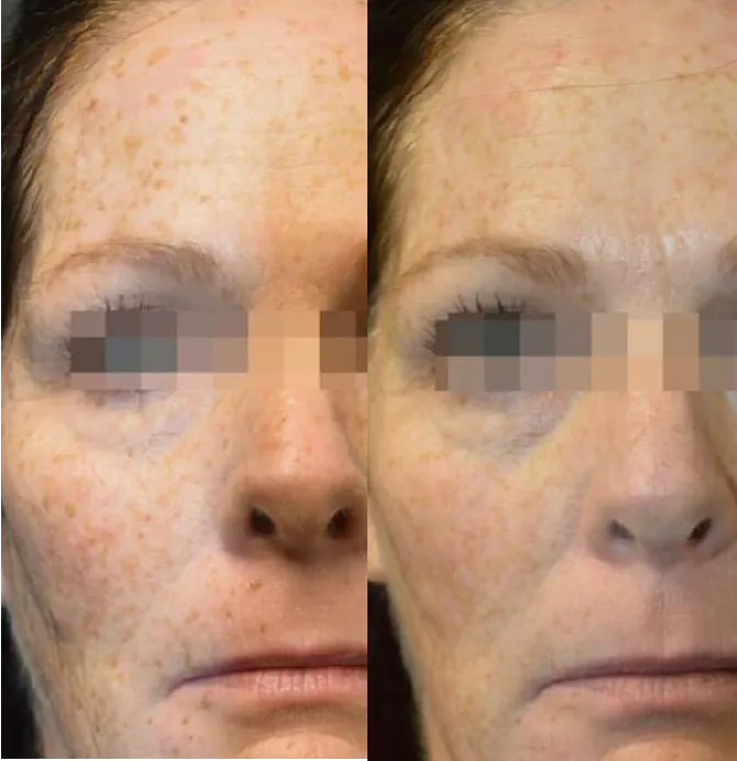 Skin Rejuvenation Solutions before and after at Glowtique Brisbane