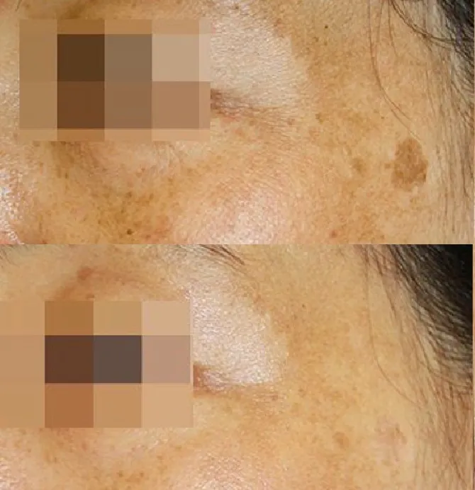 Skin Rejuvenation Solutions before and after at Glowtique Brisbane