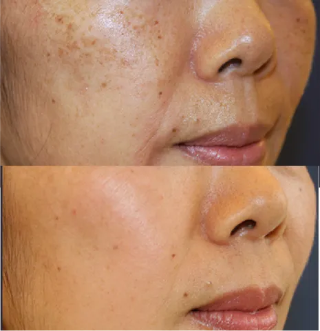 Skin Rejuvenation Solutions before and after at Glowtique Brisbane
